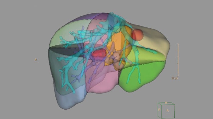 CT liver analysis