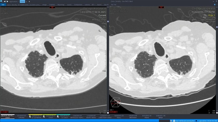 Demostración del espacio de trabajo de radiología único de Philips con visualización avanzada