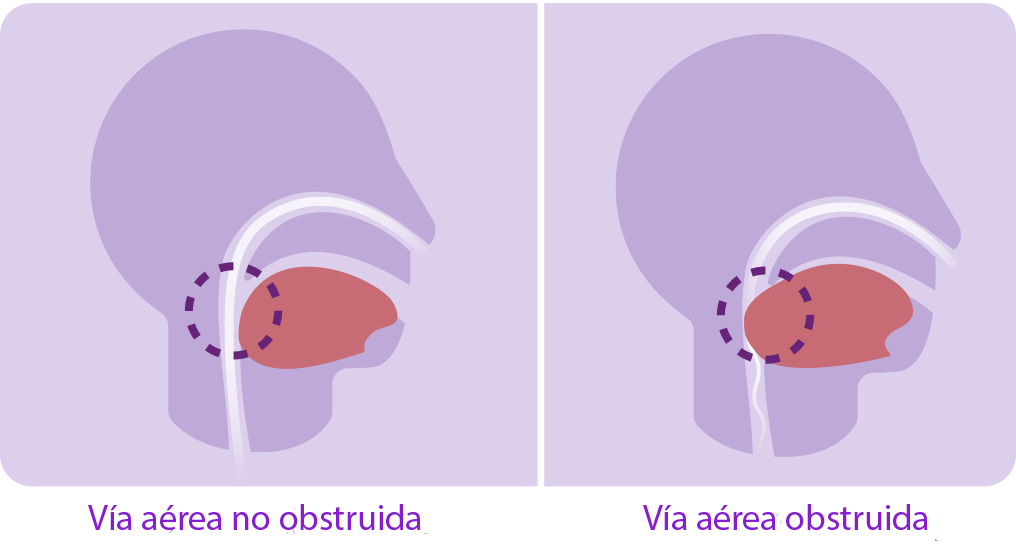 diagrama de la apnea del sueño