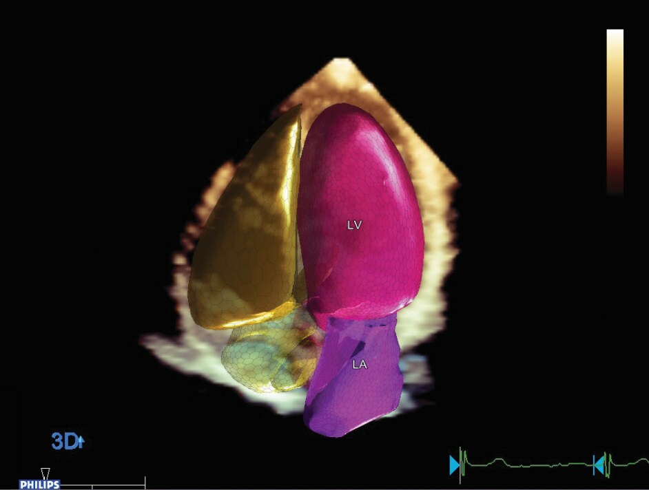 Cuantificación ecocardiográfica transtorácica 3D