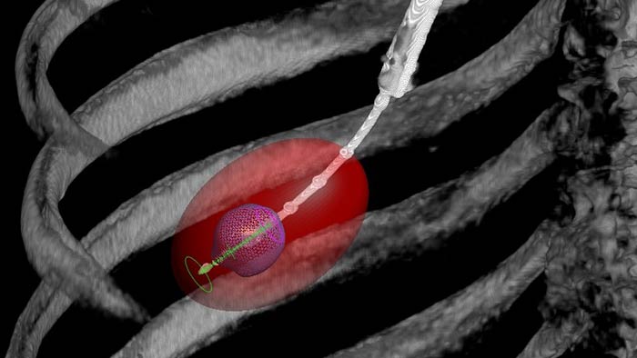XperGuide needle navigation technology with CBCT