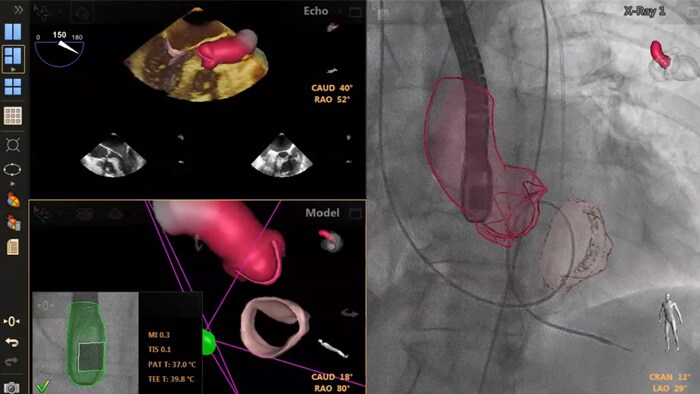 Guía de punción transeptal