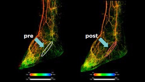 Arteria tibial posterior (Posterior Tibial Artery, PTA)