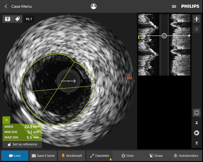 IntraSight IVUS case menu still video