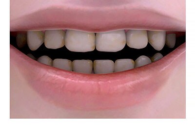 whitening